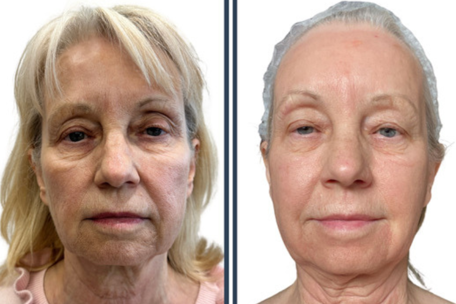 UltraClear laser resurfacing before and after result, full face renewal