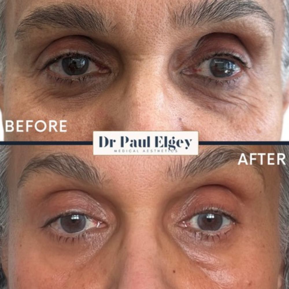 UltraClear laser resurfacing before and after result, eye area