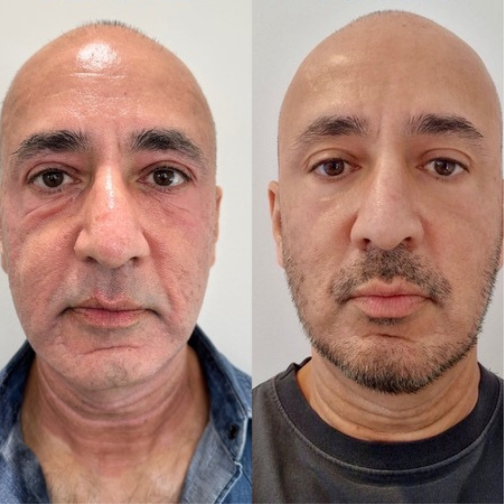 UltraClear laser resurfacing before and after result, full face renewal