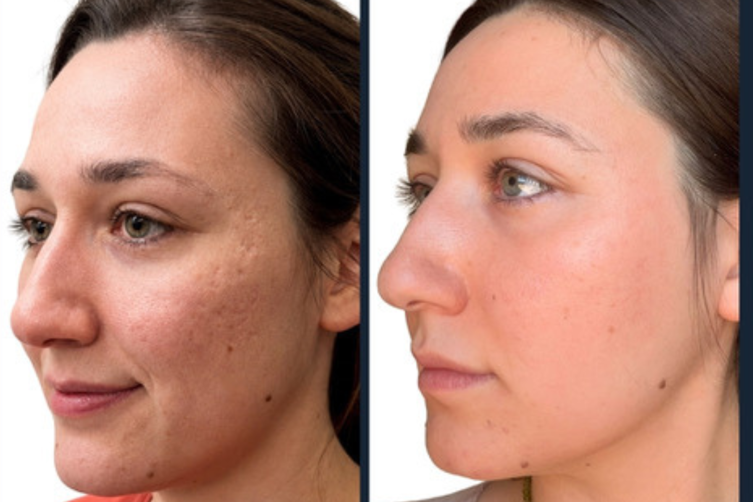 UltraClear laser resurfacing before and after result, tone and texture